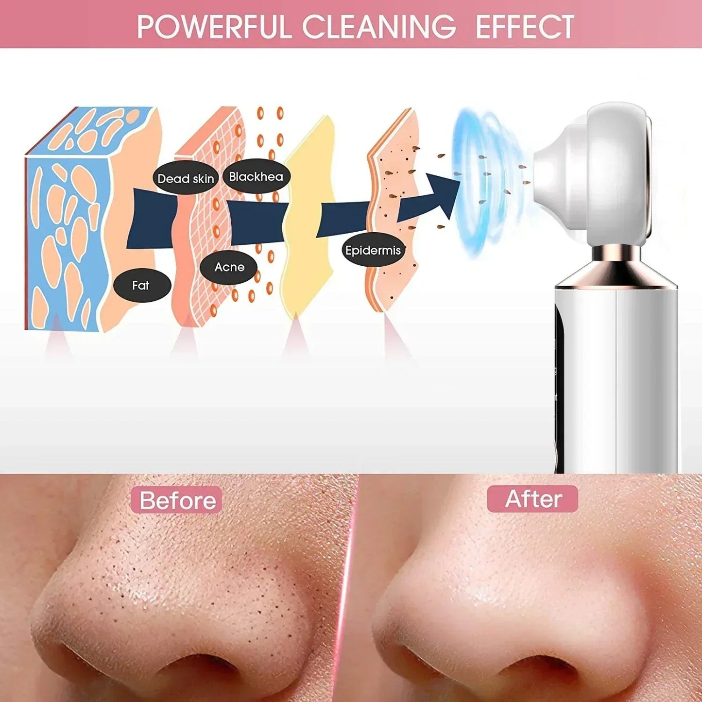 Magnifying Visible Blackhead Remover Visual Blackhead Remover Extractor Tool Set Portable Vacuum Blackhead Removal - SHOPPING YARD