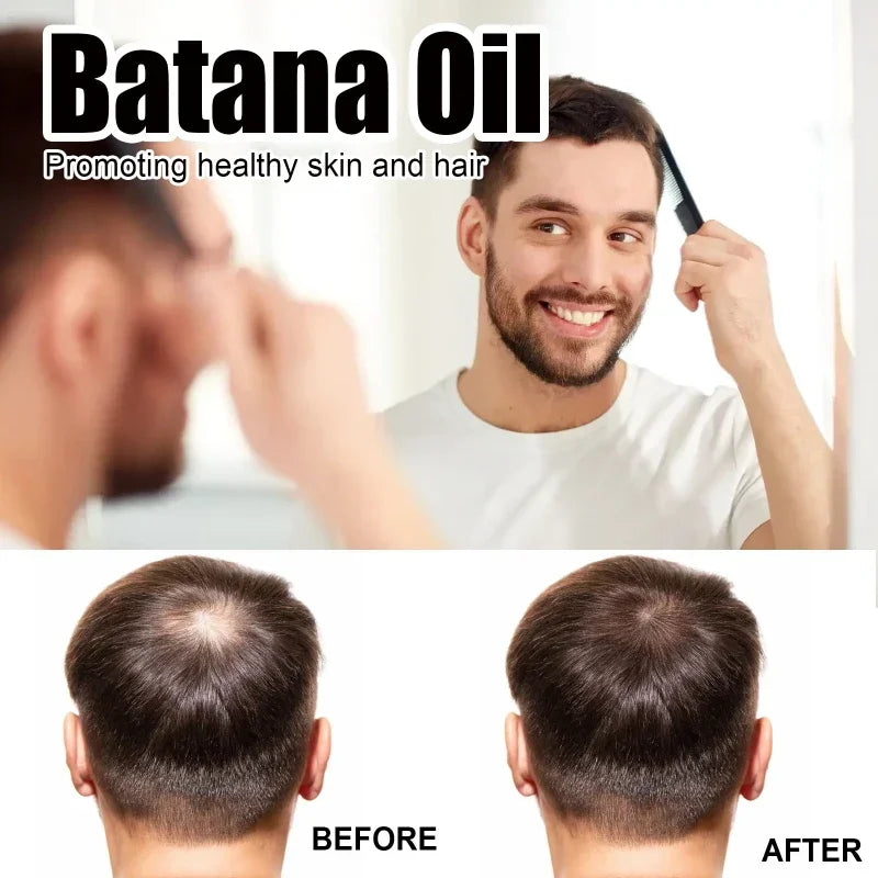 Natural Pure Batana Oil For Hair Growth Batana Oil Hair Oil Hair Loss Organic Batana Oil Hair Growth For Black Men & Women - SHOPPING YARD