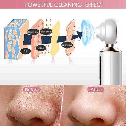 Magnifying Visible Blackhead Remover Visual Blackhead Remover Extractor Tool Set Portable Vacuum Blackhead Removal - SHOPPING YARD